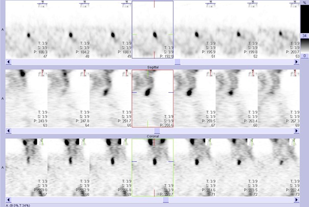 Obr. . 2: Tomografick scintigrafie krku 33 minut po aplikaci radioindiktoru