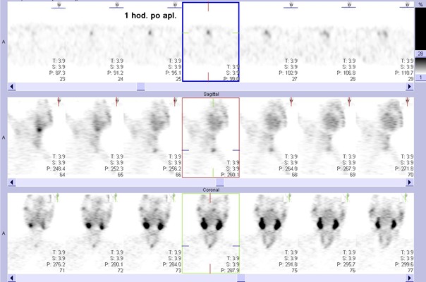 Obr. . 2: Tomografick scintigrafie krku 60 minut po aplikaci radioindiktoru