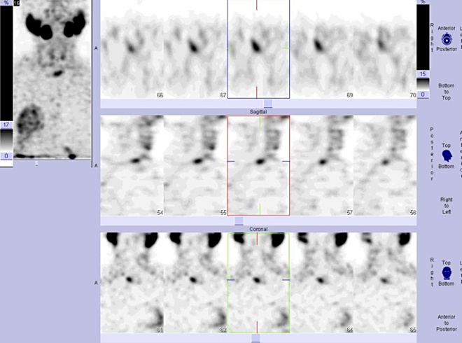 Obr. č. 3: Tomografická scintigrafie krku 190 minut po aplikaci radioindikátoru