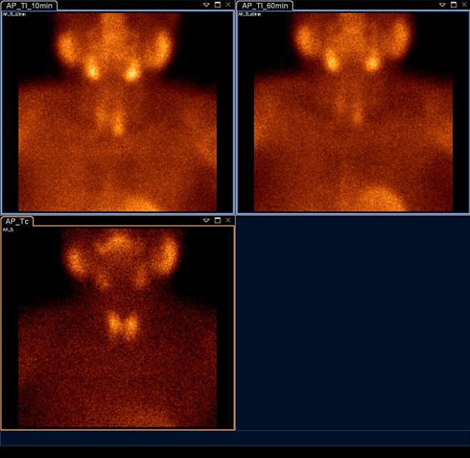 Obr.2.: Planární scintigrafie v AP projekci pomocí 99mTc-pertechnetátu (vlevo dole) a 99mTc-MIBI (1.fáze vlevo nahoře, 2.vpravo nahoře) se zřetelnou akumulací MIBI v blízkosti dolního pólu levého laloku štítné žlázy a zpomaleným vyplavováním.