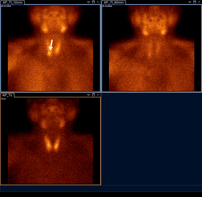 Obr.1.: Planární scintigrafie v AP projekci pomocí 99mTc-pertechnetátu (vlevo dole) a 99mTc-MIBI (1. fáze vlevo nahoře, 2. vpravo nahoře) se zřetelnou akumulací MIBI v blízkosti dolního pólu pravého laloku štítné žlázy a zpomaleným vyplavováním.