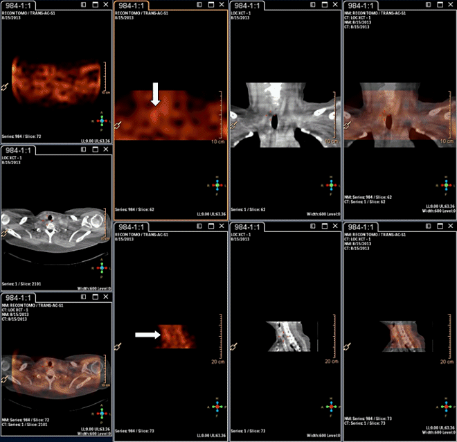 Obr.2.: Scintigrafie pomocí 99mTc-MIBI metodou SPECT/CT  se zřetelnou patologickou ložiskovou depozicí radiofarmaka v blízkosti dolního pólu pravého laloku štítné žlázy.