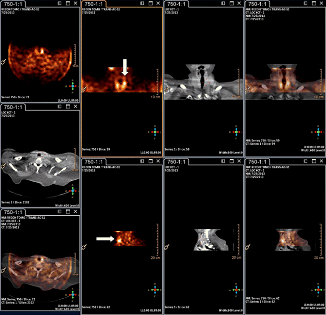 Obr.2.: Scintigrafie pomocí 99mTc-MIBI metodou SPECT/CT  se zřetelnou patologickou ložiskovou depozicí radiofarmaka v blízkosti horního pólu levého laloku štítné žlázy.