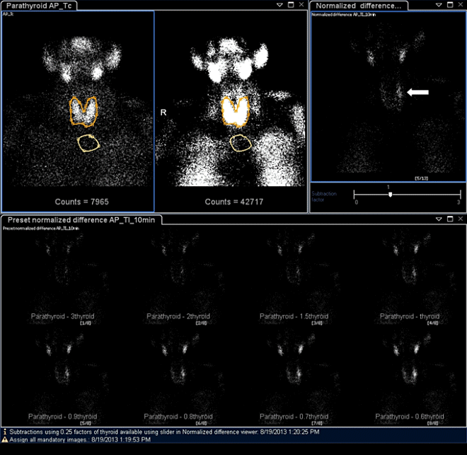 Obr.3.: Nález patologického ložiskového nahromadění radiofarmaka v blízkosti horního pólu levého laloku štítné žlázy po provedení počítačové subtrakce.