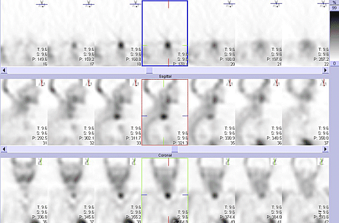 Obr.č.4: Tomografická scintigrafie krku 193 minut po aplikaci radioindikátoru. Horní řada: transverzální  řezy, prostřední řada snímků: sagitální  řezy, dolní řada: řezy koronární.