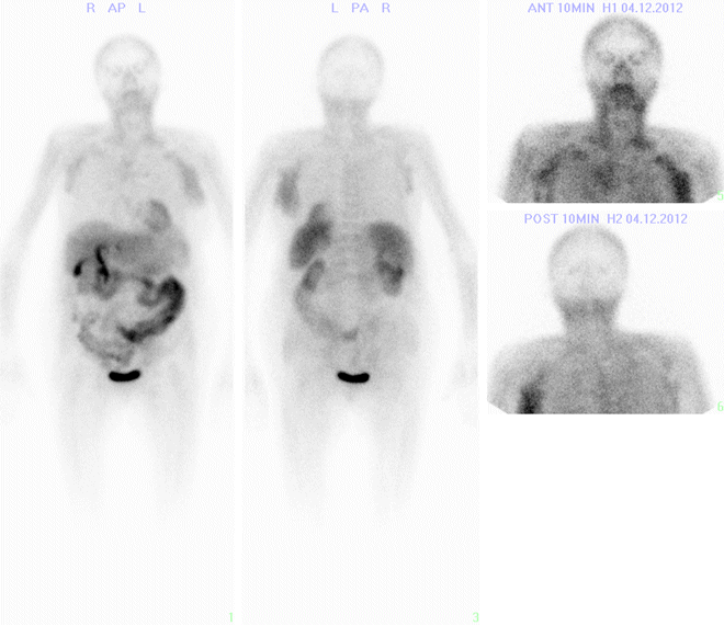 Obr. č. 3: Zkrácený WB-scan v přední i zadní projekci.