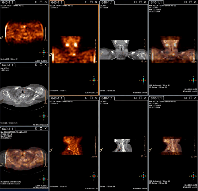 Obr.3.: Scintigrafie pomocí 99mTc-MIBI metodou SPECT/ldCT  se zřetelnou patologickou ložiskovou depozicí radiofarmaka v blízkosti dolního pólu levého laloku štítné žlázy.