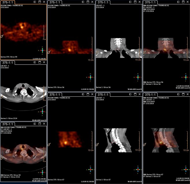 Obr.3.: Scintigrafie pomocí 99mTc-MIBI metodou SPECT/CT  se zřetelnou patologickou ložiskovou depozicí radiofarmaka dorzomediálně od dolního pólu pravého laloku štítné žlázy.