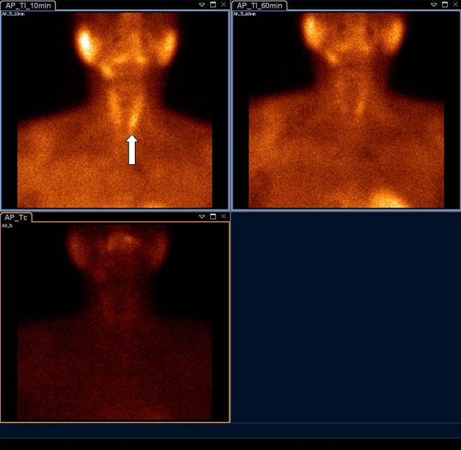 Obr.1.: Planární scintigrafie v AP projekci pomocí 99mTc-pertechnetátu (vlevo dole) a 99mTc-MIBI (1.fáze vlevo nahoře, 2.vpravo nahoře) se zřetelnou akumulací MIBI v blízkosti dolního pólu levého laloku štítné žlázy a zpomaleným vyplavováním radiofarmaka.