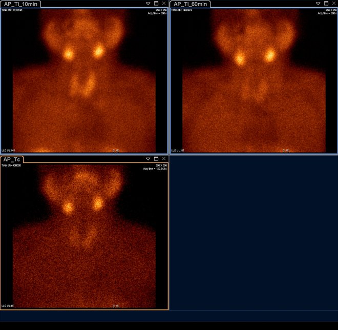 Obr.1.: Planrn scintigrafie v AP projekci pomoc 99mTc-pertechnettu (vlevo dole) a 99mTc-MIBI (1. fze vlevo nahoe, 2. vpravo nahoe) bez zeteln patologick loiskov akumulace MIBI.