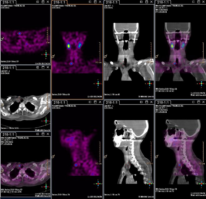 Obr.4: Scintigrafie pomocí 99mTc-MIBI metodou SPECT/ldCT  se zřetelnou patologickou ložiskovou depozicí radiofarmaka  lokalizovanou  ventrokaudálně od dolního pólu pravého laloku štítnice.