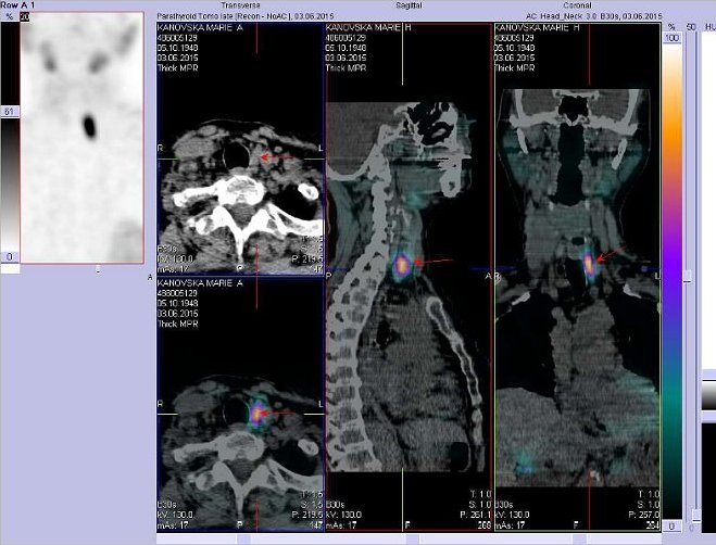 Obr. . 3: Fze obraz SPECT a CT. Vyeten ti hodiny po aplikaci radioindiktoru. Vlevo nahoe SPECT - sumace koronrnch ez. Vpravo fze SPECT a CT - ezy transverzln, ez sagitln a koronrn.