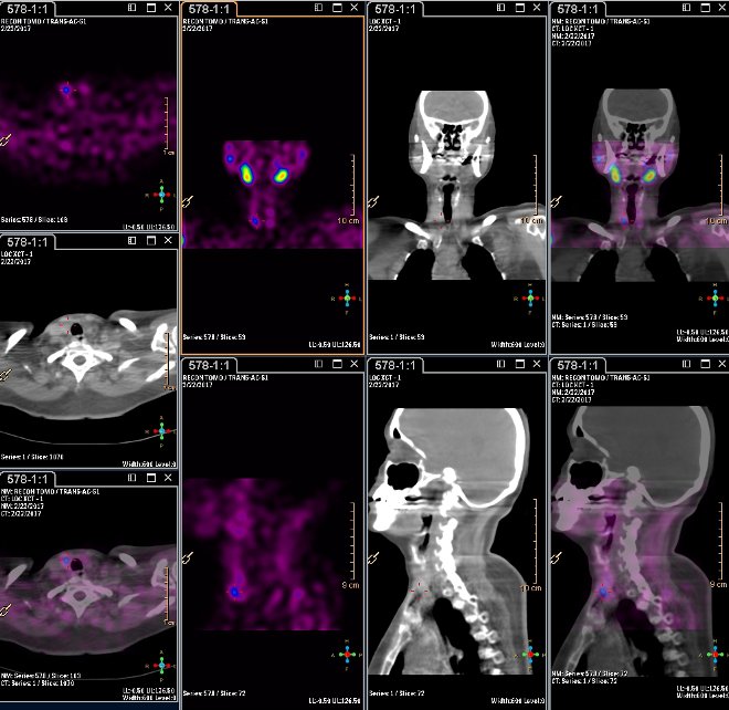 Obr.3.: Scintigrafie pomocí 99mTc-MIBI metodou SPECT/ldCT  s  patologickou ložiskovou depozicí radiofarmaka  při dolním pólu pravého laloku štítnice.