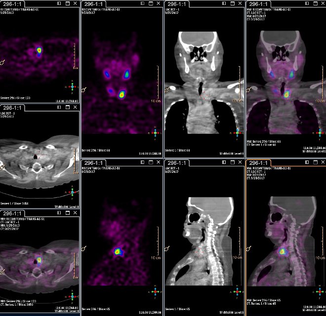 Obr.3.: Scintigrafie pomoc 99mTc-MIBI metodou SPECT/ldCT  s  patologickou loiskovou depozic radiofarmaka  pidolnm plu levho laloku ttnice.