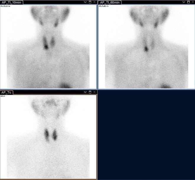 Obr.1.: Planární scintigrafie v AP projekci pomocí 99mTc-pertechnetátu (vlevo dole) a 99mTc-MIBI (1.fáze vlevo nahoře, 2.vpravo nahoře), kde zachycena patologická akumulace Tc-MIBI se zpomaleným vymýváním vpravo dole.
