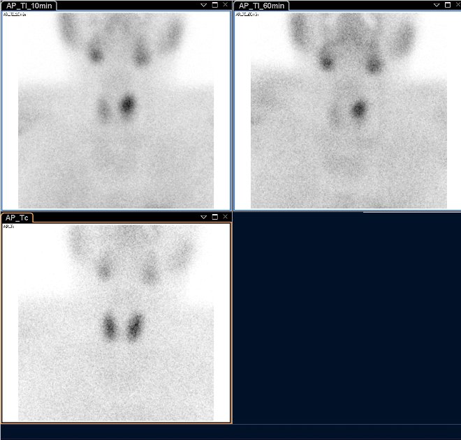 Obr.1.: Planární scintigrafie v AP projekci pomocí 99mTc-pertechnetátu (vlevo dole) a 99mTc-MIBI (1.fáze vlevo nahoře, 2.vpravo nahoře), kde zachycena patologická akumulace Tc-MIBI se zpomaleným vymýváním vlevo nahoře.