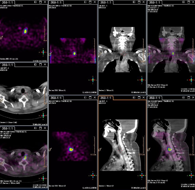 Obr.3.: Scintigrafie pomocí 99mTc-MIBI metodou SPECT/ldCT  se zřetelnou patologickou ložiskovou depozicí radiofarmaka  s projekcí k zadnímu okraji horního pólu levého laloku štítnice.