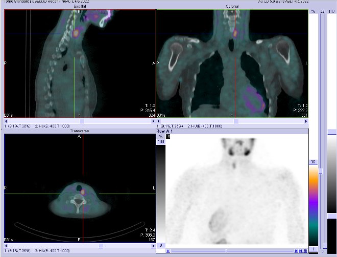Obr.2.: Scintigrafie pomocí 99mTc-MIBI metodou SPECT/ldCT  se zřetelnou patologickou ložiskovou depozicí radiofarmaka  lokalizovanou  dorzálně od horního pólu levého laloku štítnice.
