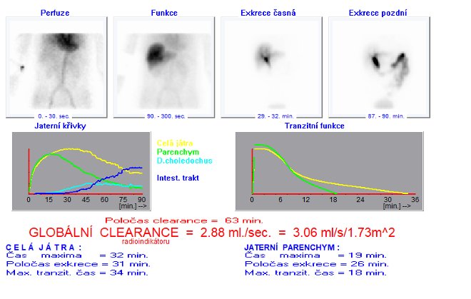 Obr..1: Dynamick scintigrafie jater a luovch cest  cholescintigrafie. Doba stdn po dobu 90 minut od aplikace radiofarmaka.