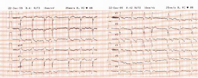 záznam EKG