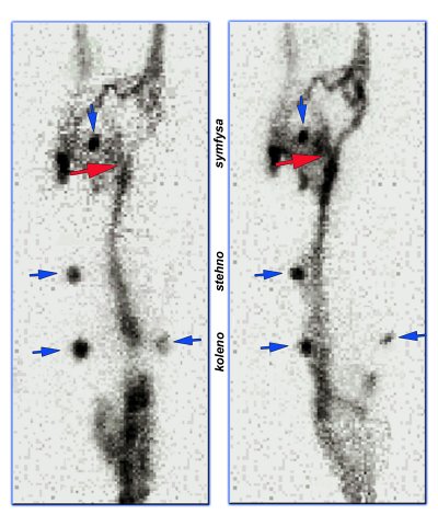 Obr. 1a,b: Radionuklidová flebografie LDK (instruktivní výběr z obrazů). Modré šipky označují lokalizační značky – koleno – stehno – symfysa. Červené šipky označují neprůchodný segment hlubokého žilního systému.