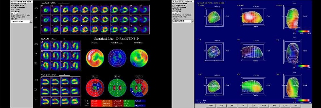 Obr. č. 7: Gatovaná tomografická scintigrafie myokardu na kameře Intevo Siemens s tomografickým systémem IQ-SPECT s multifokálními kolimátory SMARTZOOM.