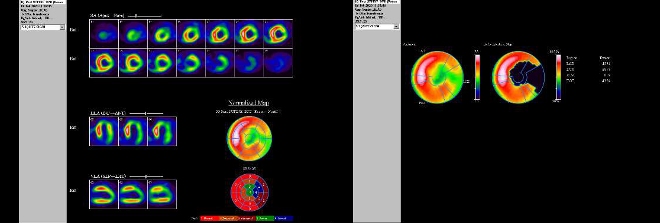 Obr. č. 8: Gatovaná tomografická scintigrafie myokardu na kameře Intevo Siemens s tomografickým systémem IQ-SPECT s multifokálními kolimátory SMARTZOOM.