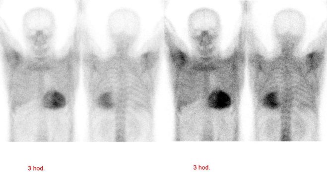 Obr. č. 4: „Celotělová“ scintigrafie v přední a zadní projekci v délce 70 cm. Vyšetření 3 hodiny po aplikaci radiofarmaka.