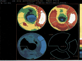 201Tl: perfúze myokardu-polární mapy