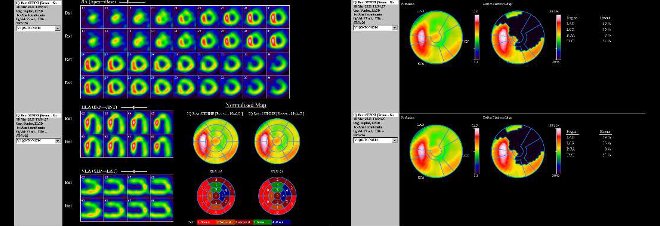Obr. č. 6: Gatovaná tomografická scintigrafie myokardu na kameře Intevo Siemens s tomografickým systémem IQ-SPECT s multifokálními kolimátory SMARTZOOM.