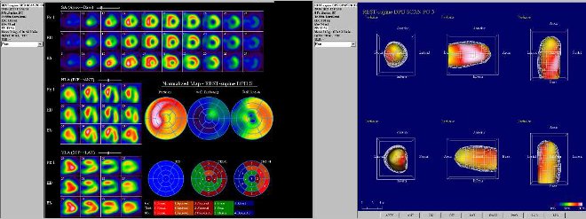 Obr. č. 8: Gatovaná tomografická scintigrafie myokardu na kameře Intevo Siemens s tomografickým systémem IQ-SPECT s multifokálními kolimátory SMARTZOOM.