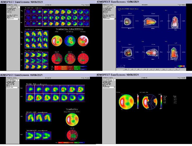 Obr. č. Gatovaná tomografická scintigrafie myokardu na kameře Intevo Siemens s tomografickým systémem IQ-SPECT s multifokálními kolimátory SMARTZOOM.