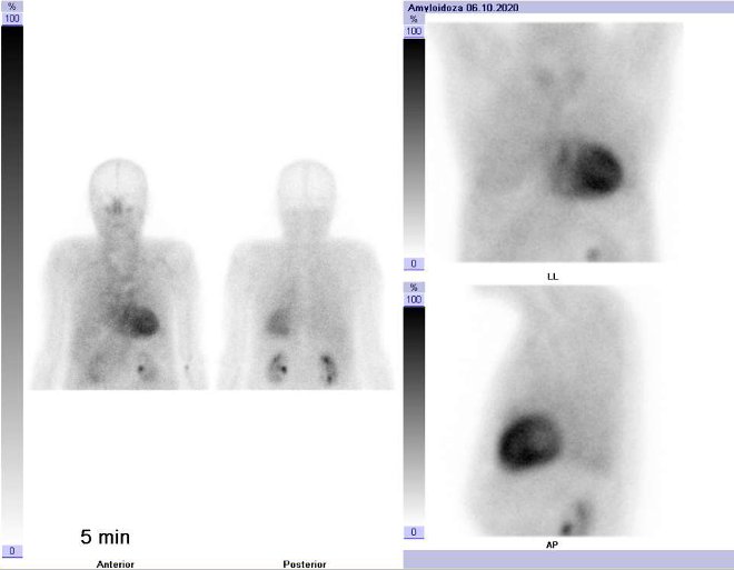 Obr.1: „Celotělová“ scintigrafie v přední a zadní projekci a statická scintigrafie hrudníku v přední a levé boční projekci. Vyšetření 5 a 10 minut po aplikaci radiofarmaka.
