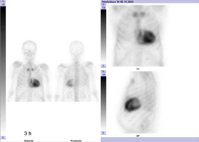 Obr.č.2: „Celotělová“ scintigrafie v přední a zadní projekci a statická scintigrafie hrudníku v přední a levé boční projekci. Vyšetření 3 hodiny po aplikaci radiofarmaka.
