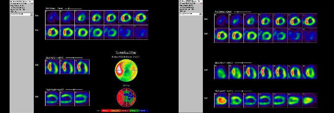 Obr. . 5: Gatovan tomografick scintigrafie myokardu na kamee Intevo Siemens s tomografickm systmem IQ-SPECT s multifoklnmi kolimtory SMARTZOOM.