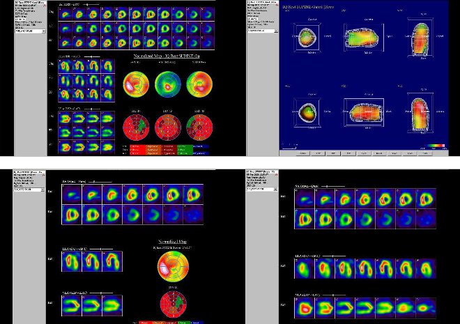 Obr. . 5: Gatovan tomografick scintigrafie myokardu na kamee Intevo Siemens s tomografickm systmem IQ-SPECT smultifoklnmi kolimtory SMARTZOOM.