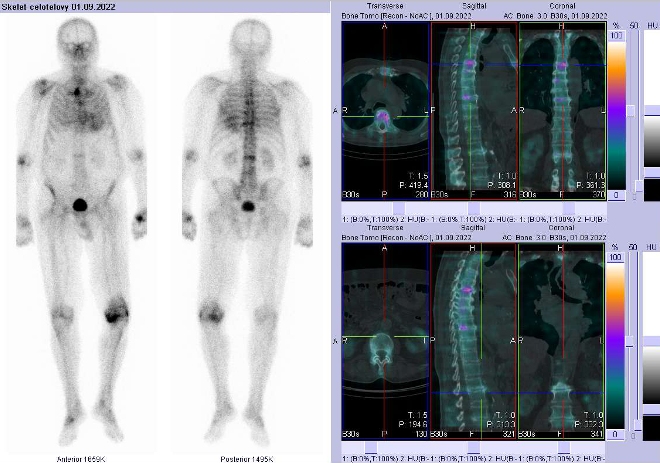 Obr.1: Celotlov scintigrafie vpedn a zadn projekci a fze obraz SPECT a CT.  Vpravo zameno na loisko v Th a L ptei.