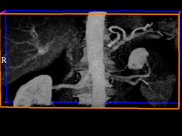 Obr. 2: CT angiografie abdominální aorty a renálních tepen ve 3D zobrazení