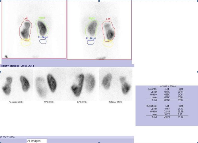Obr. č. 2: Statická scintigrafie ledvin v zadní, přední a obou zadních šikmých  projekcích v poloze vleže.