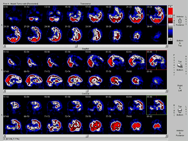 Obr. . 1: SPECT mozku na dvouhlav tomografick kamee.