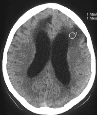 Obr. . 1: CT mozku 19.7.2005  patrn hypodenzn loisko a rozen mozkovch komor.