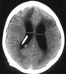 Obr. . 2: CT mozku 29.7.2005  patrn hypodenzn loisko a rozen mozkovch komor.