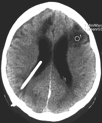 Obr. . 4: CT mozku 3. 8. 2005  patrn hypodenzn loisko a ji regredujc hydrocefalus.