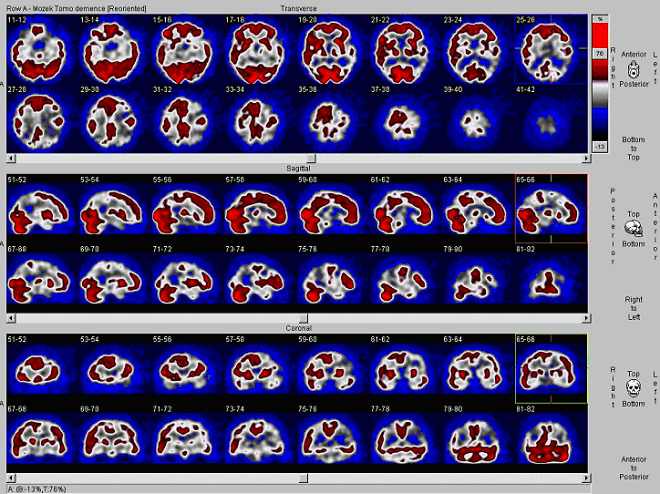 Obr. . 1: SPECT mozku na dvouhlav tomografick kamee. Horn dv ady scintigram: transaxiln ezy, prostedn dv ady scintigram: sagitln ezy, doln dv ady scintigram: koronln ezy