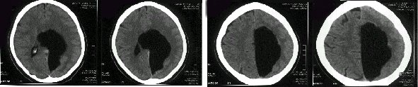 Obr. . 1: CT hlavy: rozshl cysta parietln vlevo