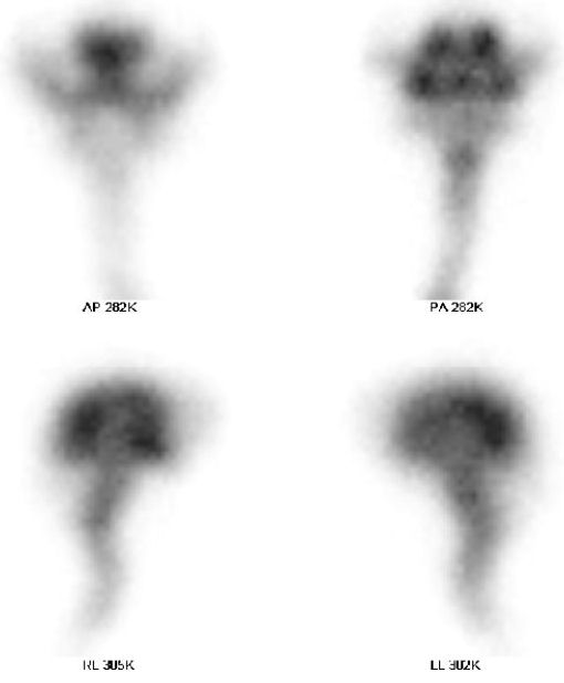 Obr. . 1: Radionuklidov cisternografie  scintigrafie za 5 hod., nahoe pedn a zadn projekce, dole prav a lev bon projekce.