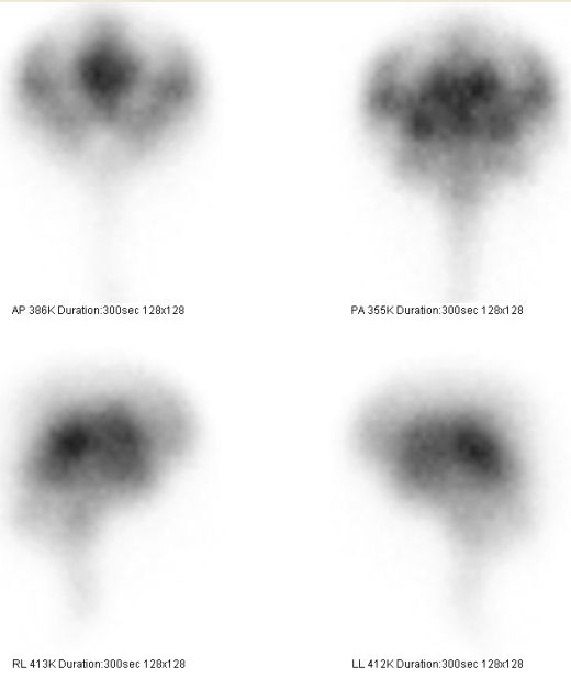 Obr. . 2: Radionuklidov cisternografie scintigrafie za 24 hod., nahoe pedn a zadn, projekce, dole prav a lev bon projekce.