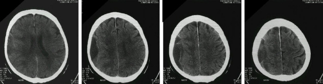 Obrzek . 2: CT mozku (vybran ezy) Vpravo parietln pod kalvou tvar 92x30x30 mm, bez sycen postkontrastn, v okol hyperdenzn lem, naznaen septa uvnit tvaru, zal subarachnoideln prostory na konvexit vpravo. Zvr: chronick subdurln hematom vpravo parietln