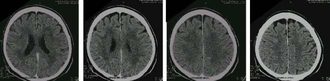 Obrzek . 3: CT mozku po evakuaci subdurlnho hematomu: (vybran ezy) Vpravo parietln jemnj subarachnoideln prostory ve srovnn s kontralaterln stranou, bez rozen subdurlnho prostoru