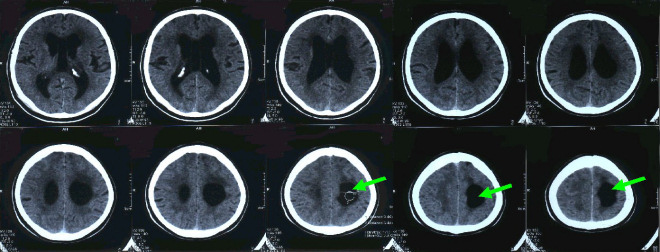 Obrzek . 1: CT mozku (vybran ezy): Dilatace komorovho systmu (III. komory i postrannch komor), cysta parietln vlevo komunikujc s okcipitlnm rohem lev postrann komory 2,5 x 3,5 x 4 cm zasahujc vysoko pod kalvu (viz ipky). Hypodenzity kolem roh postrannch komor a lakuna v capsula interna vlevo. Gyrifikace je pravideln. Znmky cytotoxickho edmu v povod ACM vpravo t.. neprokzny.